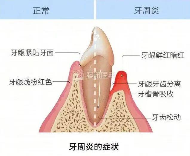 30块的牙线和300块的冲牙器，牙医更推荐哪个？答案出乎意料