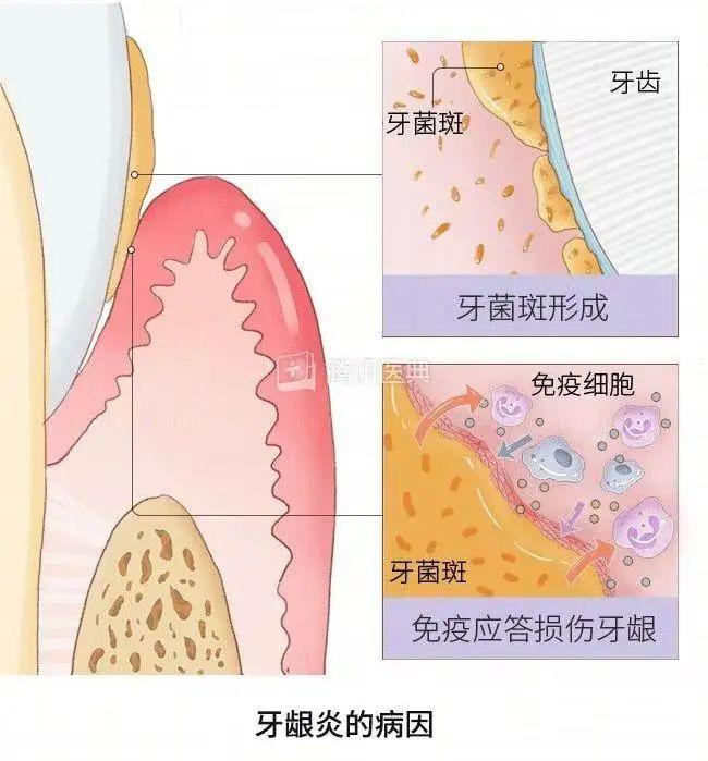 30块的牙线和300块的冲牙器，牙医更推荐哪个？答案出乎意料