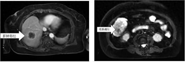 不起眼的腹痛，确诊结肠癌！医生提醒：如厕后多看一眼，早发现早治疗