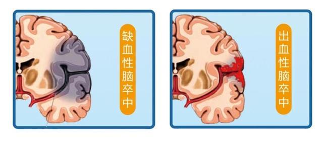 90%以上的卒中可预防！日常生活要注意这些