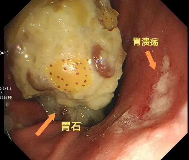 近期大量上市，有人食用后入院！紧急提醒