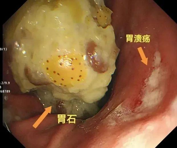 警惕！大量食用后易结石！医生提醒 →