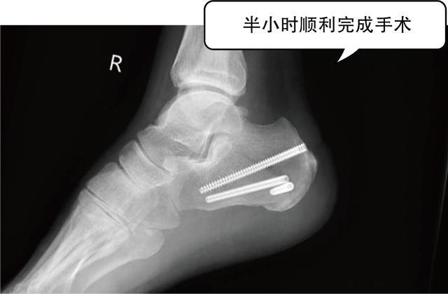 医疗前沿，微创技术如何改变跟骨骨折手术？