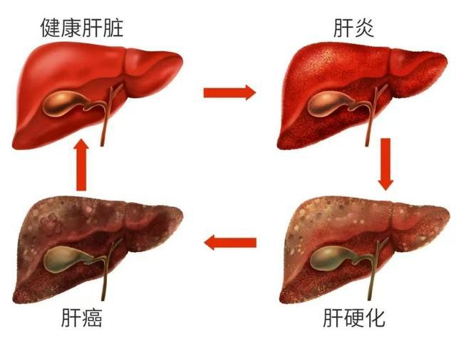 学点“肝”货，告别“肝”扰——沪东社区中医肝病科门诊