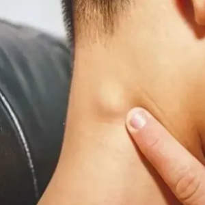 小淋巴结怎么治 w300h300z1l10t10q1005ff.jpg