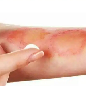 多大的伤口会发炎 w300h300z1l10t10q100529.jpg