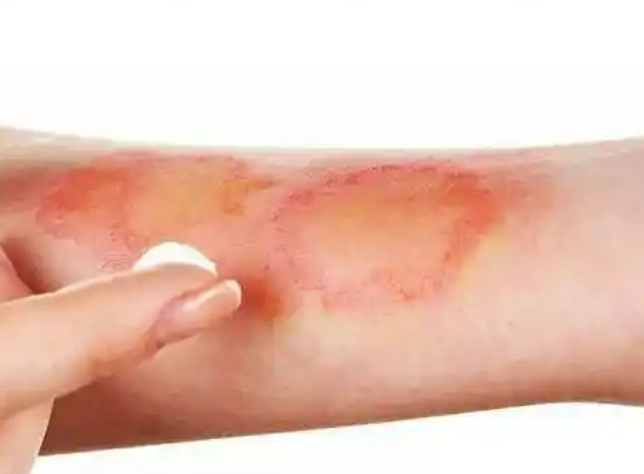 手术疤痕修复哪家好 w700d1q75cms.jpg?by=cms_fixed_width