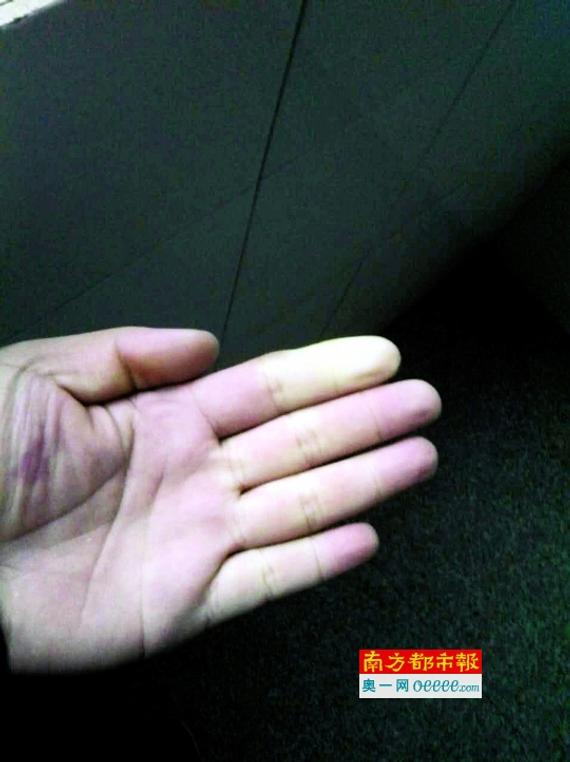 今年年初，陈伟的手上出现青紫发白的现象。 受访者供图