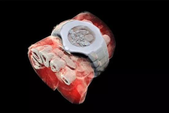 图为MARS扫描仪拍摄的带手表手腕部分的3D彩色X射线图像,白色的是软组织中的部分手指骨,连手表的结构都能完整重现(图片来自网络)