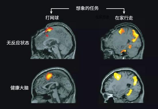 部分患者看起来对外界刺激无反应,但是其大脑活动与健康个体的类似。