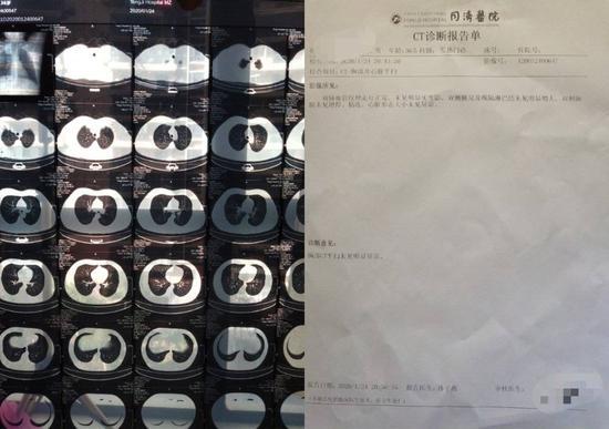 后觉的CT拍片结果与诊断报告单(姓名与医生姓名已隐去)