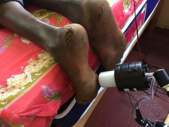 使用仪器测试足底皮肤硬度、厚度与敏感度