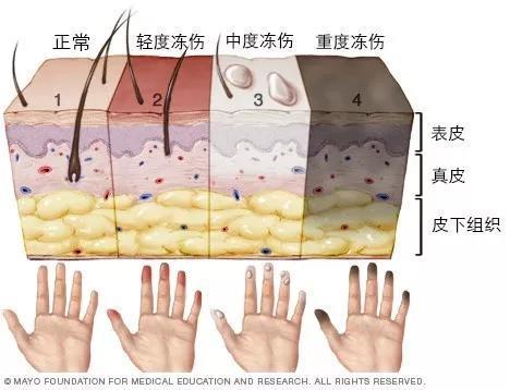 冻伤程度对应图。图片来源:https://www.mayoclinic.org/diseases-conditions/frostbite/multimedia/img-20114490