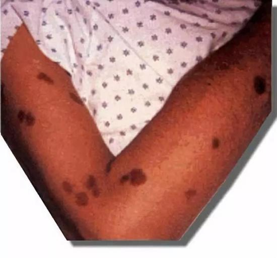 图3 卡波氏肉瘤