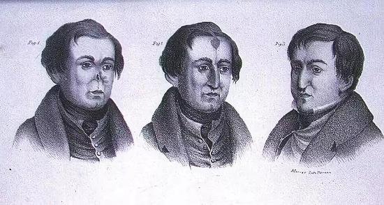1840年有关自体塑形的鼻子整形术图解。图源:Kashmir Observer