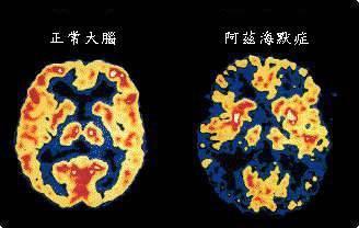 ▲老年痴呆症,也叫“阿尔茨海默症”。与正常人的大脑相比,老年痴呆症患者大脑出现了萎缩