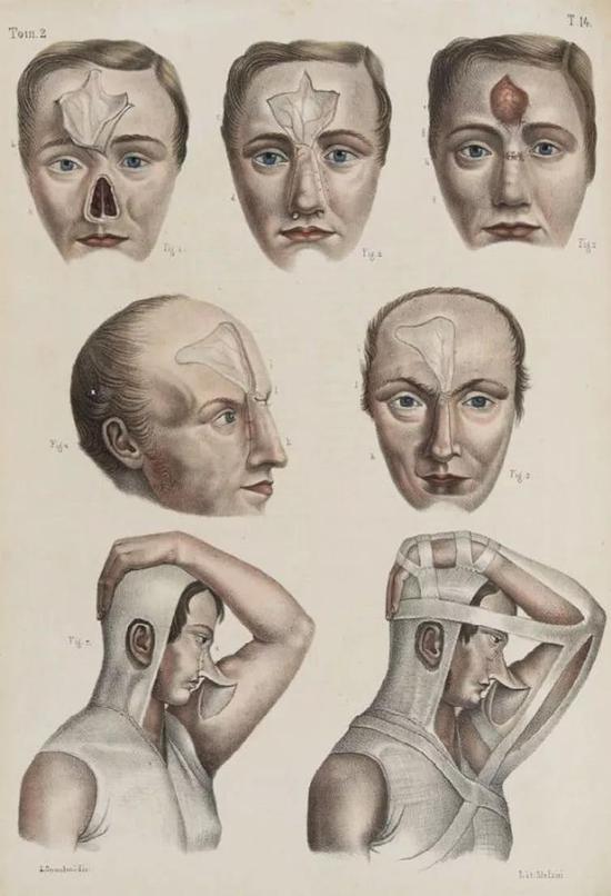 让·巴普蒂斯·马克·布尔热利(Jean Baptiste Marc Bourgery)和尼古拉斯·亨利·雅各布(Nicholas Henri Jacob)的“外科解剖学和影像解剖学”(Iconografia d‘anatomia chirurgica e di medicina operatoria),佛罗伦萨,1841年。图源:Pinterest