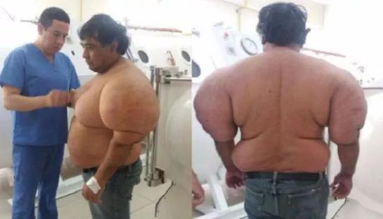 减压病让一名男子(Alejandro Ramos Martinez)肿得像个气球
