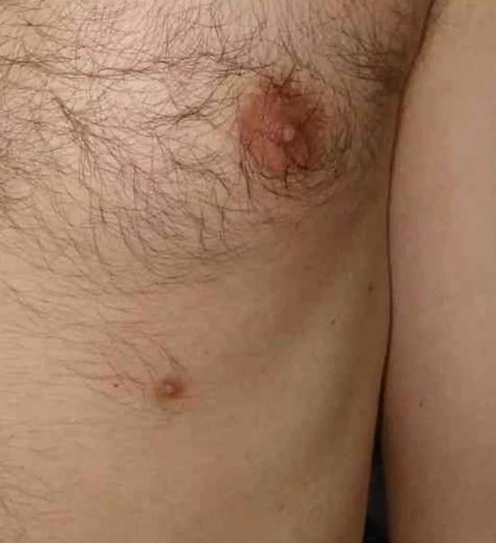 另一个常见的例子就是长有多余的乳头。Zureks/维基百科共享资源