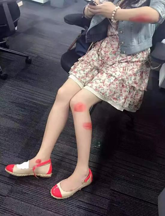 △同事给乔杉拍的照片,还发了朋友圈,说她负伤上班,爱岗敬业