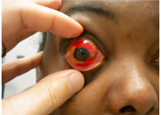 这位31岁的非裔女性患者。丨参考文献3