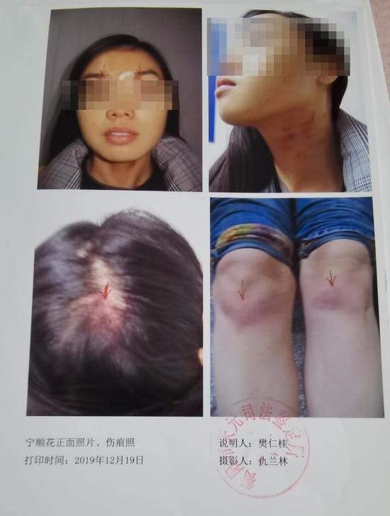 宁顺花被陈定华殴打的伤情照片 图片来源/上游新闻