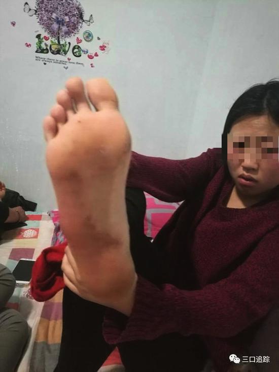 妹妹和我的双脚都是血