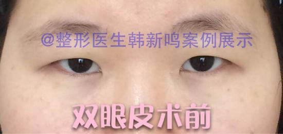 双眼皮术前