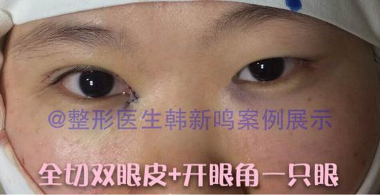 双眼皮术后