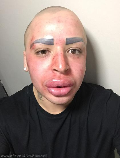 Jordan最近的一次手术是争议极大的“僵尸美容”