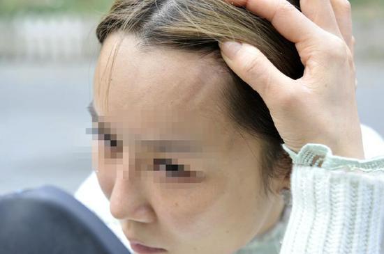 微整形后,额头留下了一道凹痕。图片来源:华西都市报