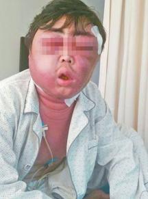 张先生面部肿胀得眼睛都睁不开。图片由本人提供