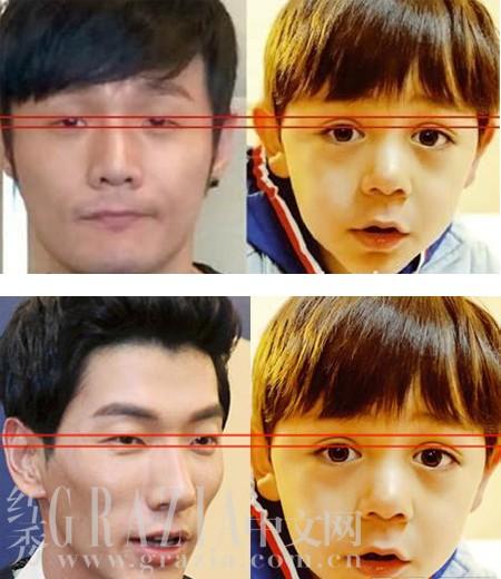 大双眼皮