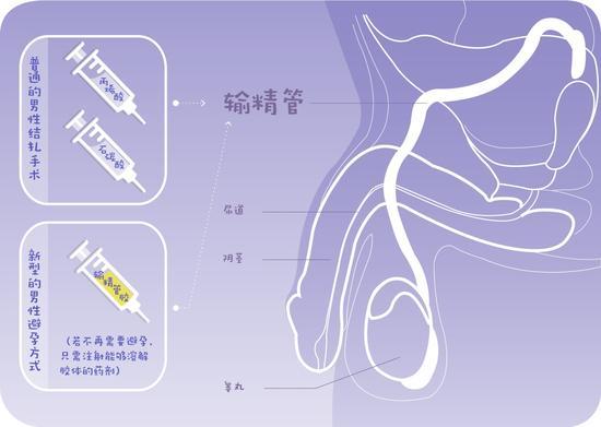 经皮输精管注射粘堵法和输精管胶法原理图(绘图 肖媛)
