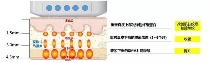 超声刀就是烤肉也没关系，因为它对脸垮是真的有效！