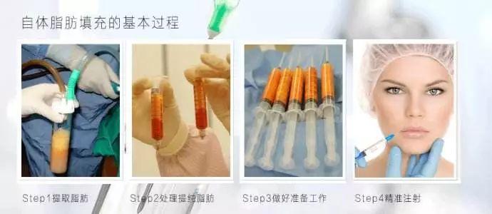 自体脂肪填充