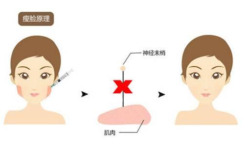 打瘦脸针会出现副作用么?