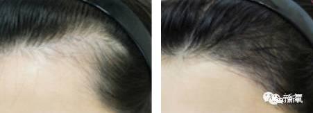 不开刀的FUE