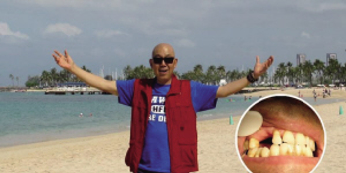 专家提醒:缺牙危害大,种牙需及时