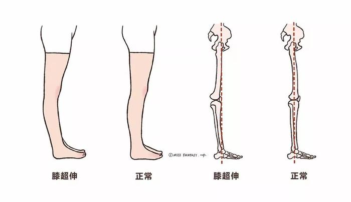 黎贝卡：站直也没用，这几个体态问题出卖了你