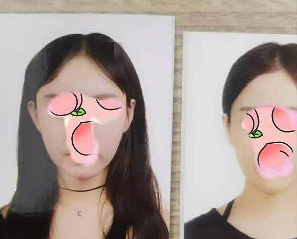 左图为术前,右图为术后(图片由受访者提供)