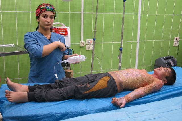 库尔德男孩70%皮肤疑被白磷灼烧，土耳其武装否认使用化学武器
