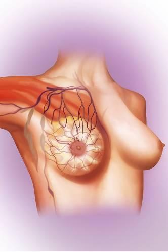 【门诊日记】王昕：我接诊的一位“0期”乳腺癌患者