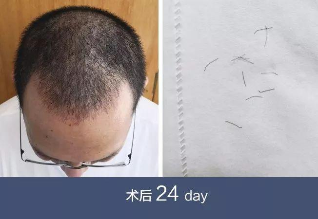 术后24天
