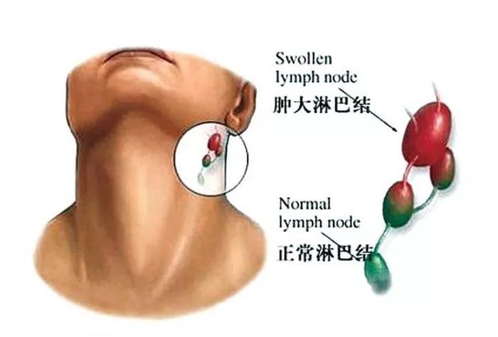 阿Sa蔡卓妍淋巴结肿大？淋巴结肿大=得癌？