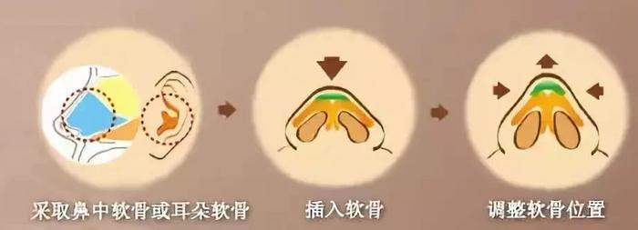 自体软骨