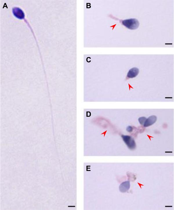 精子头尾连接异常、尾巴畸形，专家发现弱畸精子症新致病基因