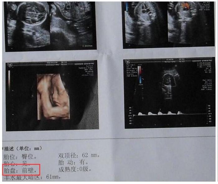 胎盘前壁和后壁，意味着胎儿的状态不同，面临的风险也不一样