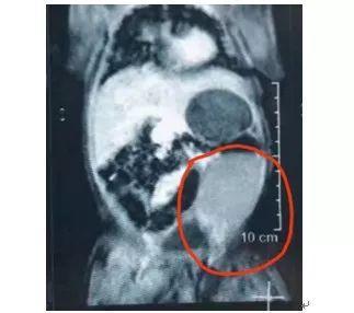 女婴卵巢惊现5厘米囊肿，医生30分钟不留痕摘除！