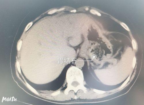 女子腹痛就医，CT照出结石，两个鸡蛋大石头